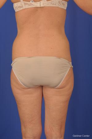 Lipoabdominoplasty: Patient 2 - Before and After Image 4