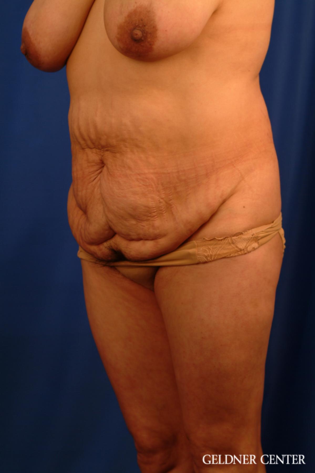 Tummy Tuck: Patient 16 - Before and After 5
