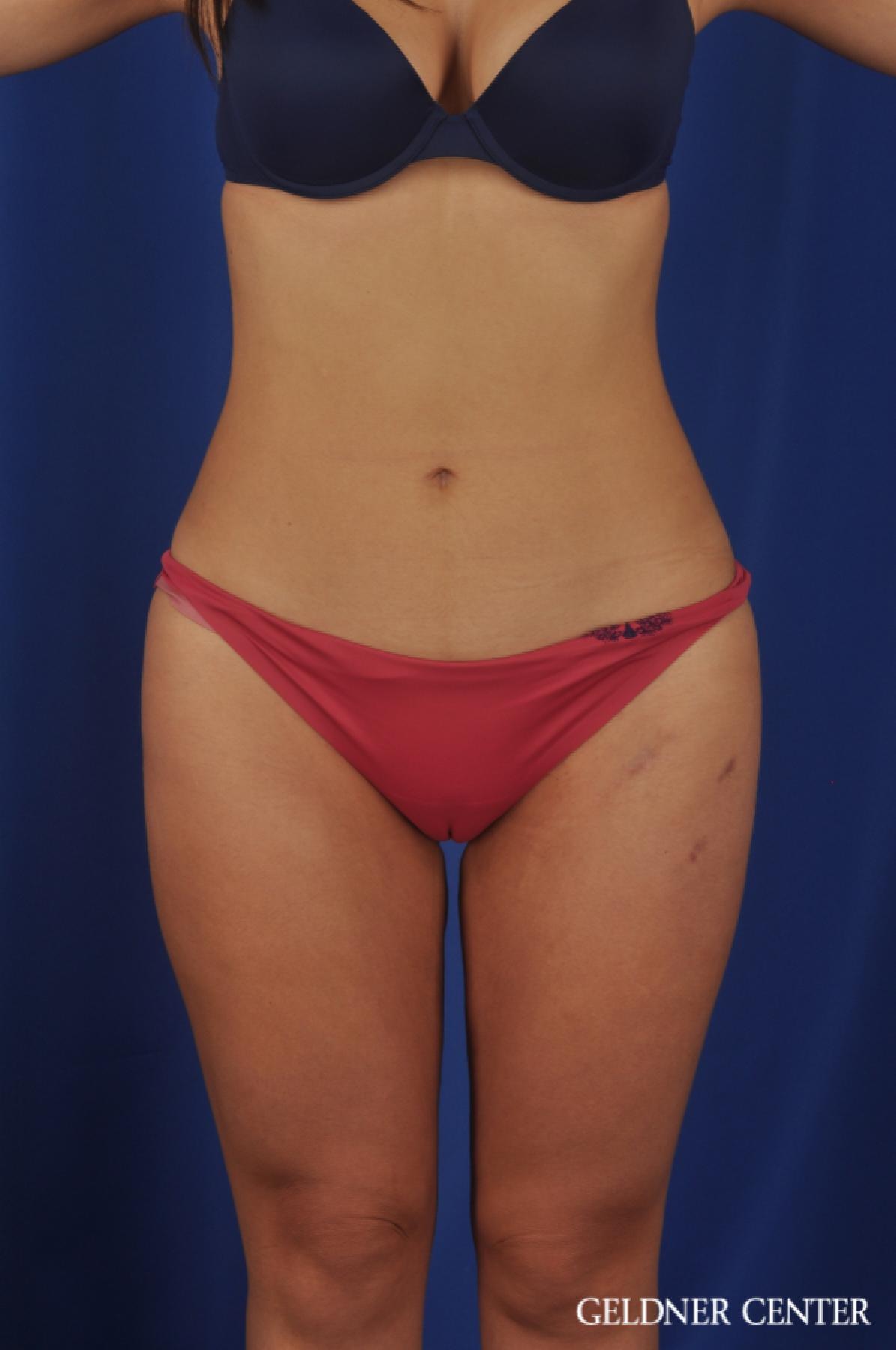 VASER® Lipo: Patient 10 - After  