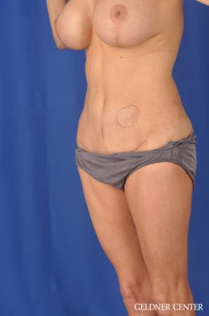 Abdominoplasty Streeterville, Chicago 11873 - After Image 4
