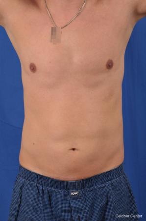 Liposuction For Men: Patient 5 - After Image 1