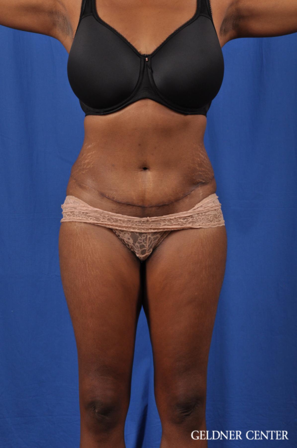 Liposuction: Patient 40 - After 