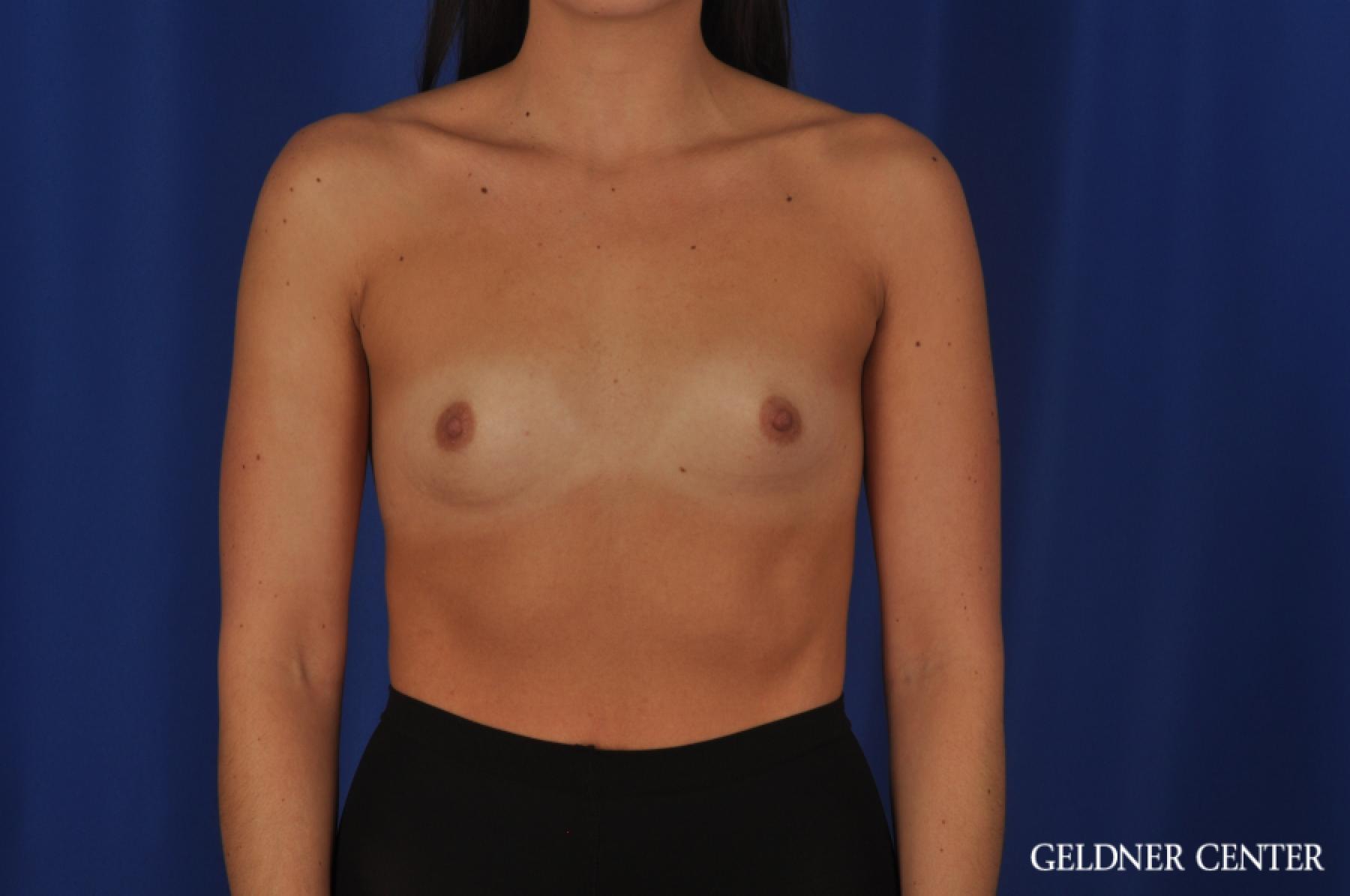 Breast Augmentation Hinsdale, 4290 - Before 1