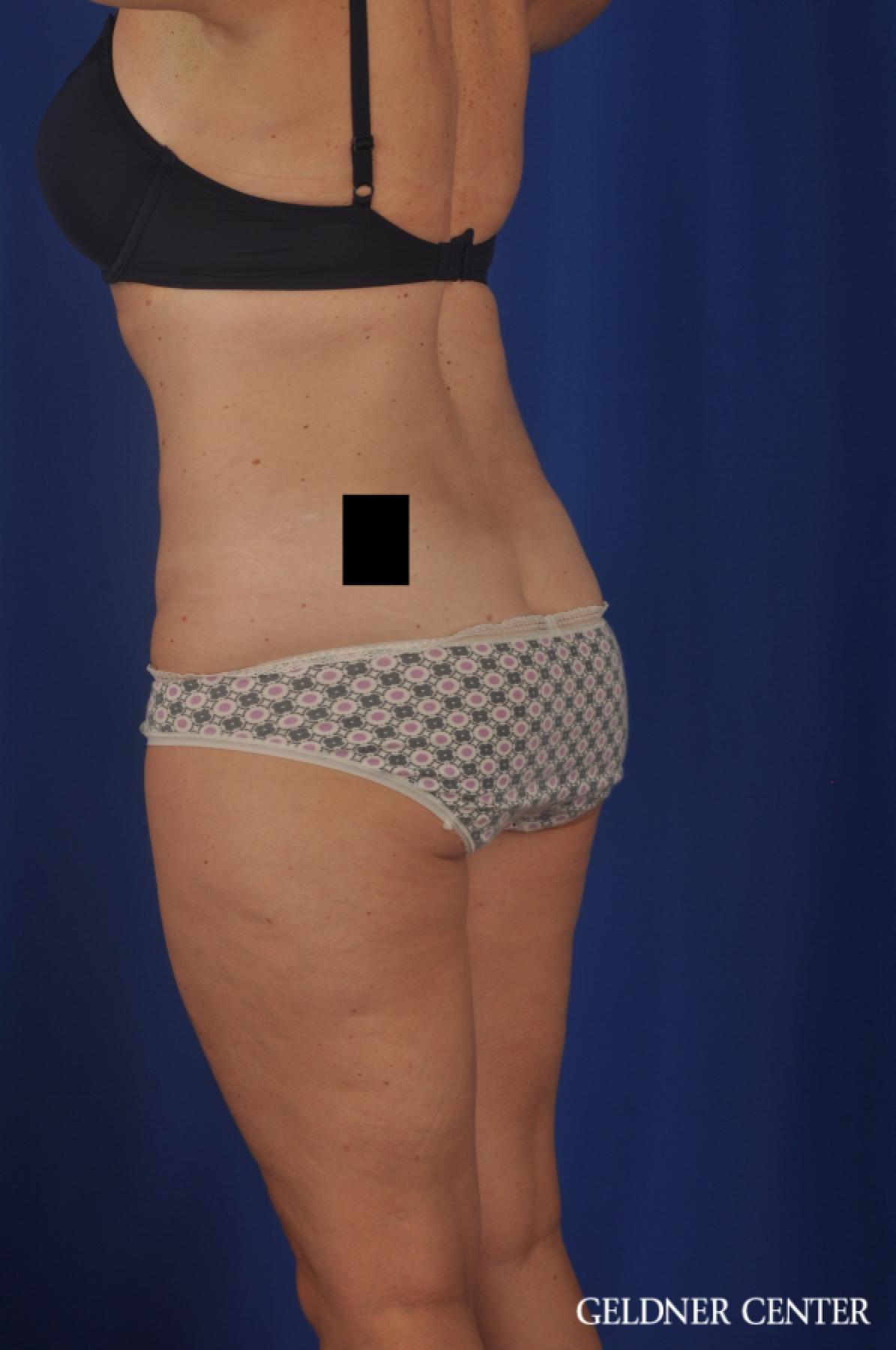 Tummy Tuck: Patient 22 - After 5