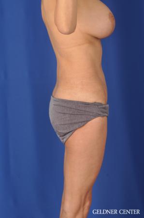 Abdominoplasty Streeterville, Chicago 11873 - After Image 3