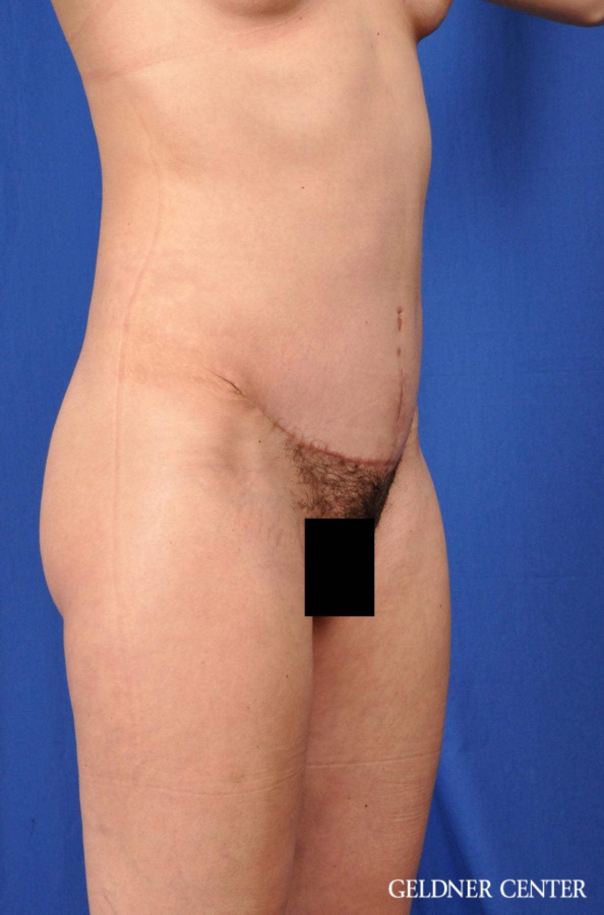 Tummy Tuck: Patient 32 - After 2