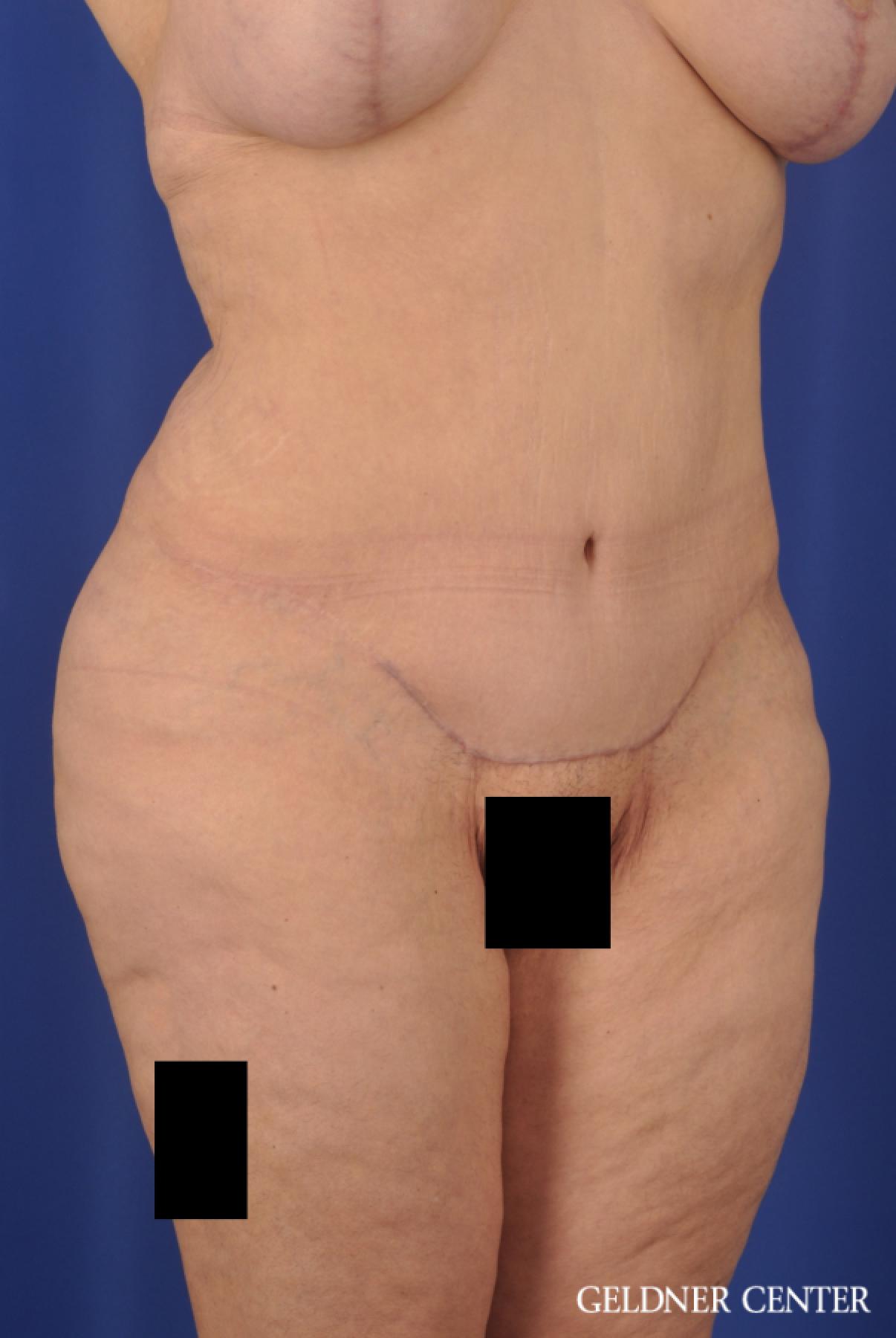 Tummy Tuck: Patient 19 - After 2