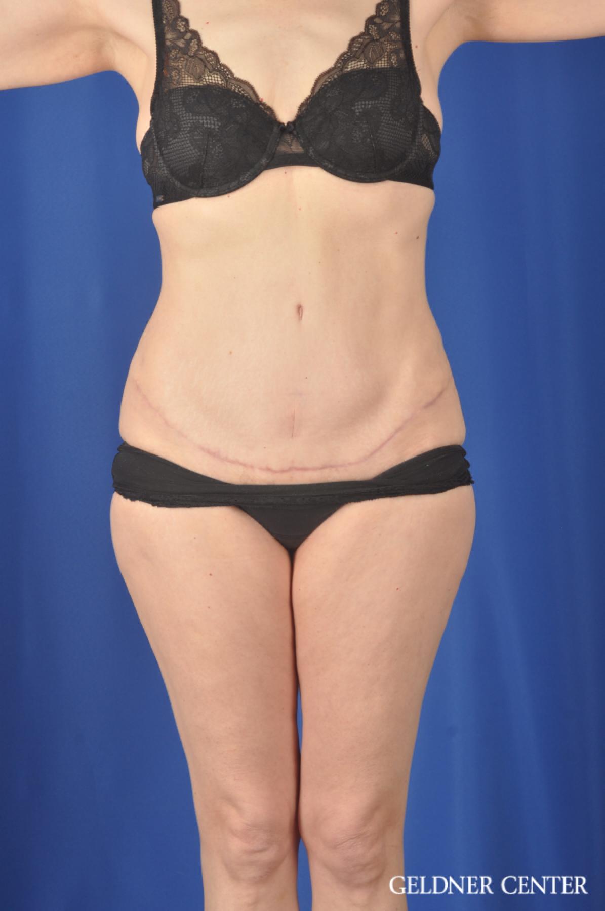 Liposuction: Patient 33 - After 