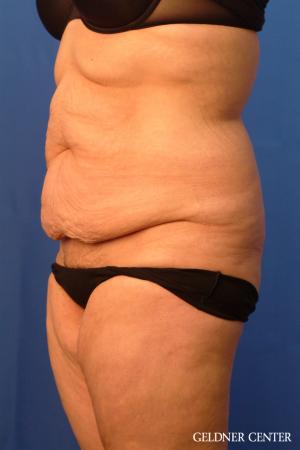Liposuction: Patient 23 - Before and After 4