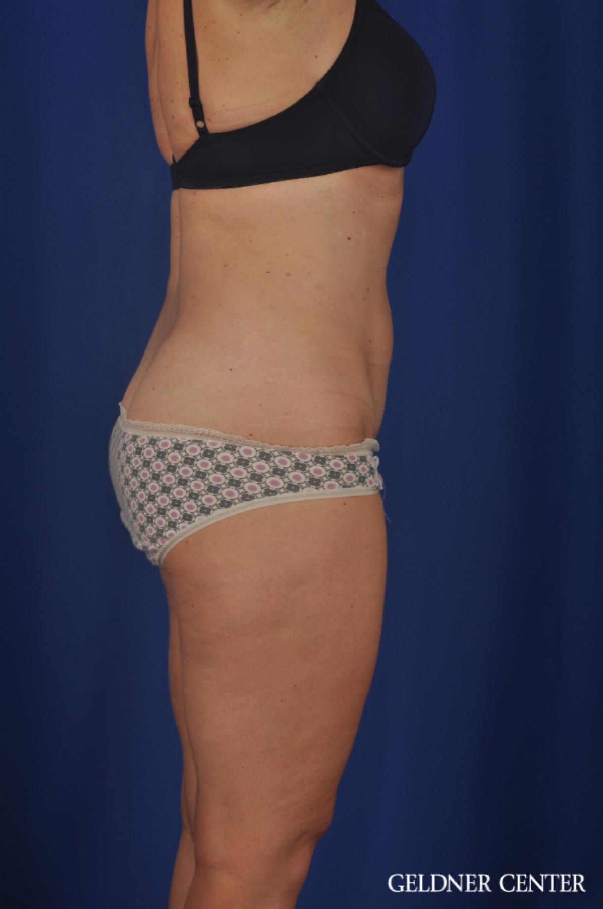 Tummy Tuck: Patient 22 - After 3