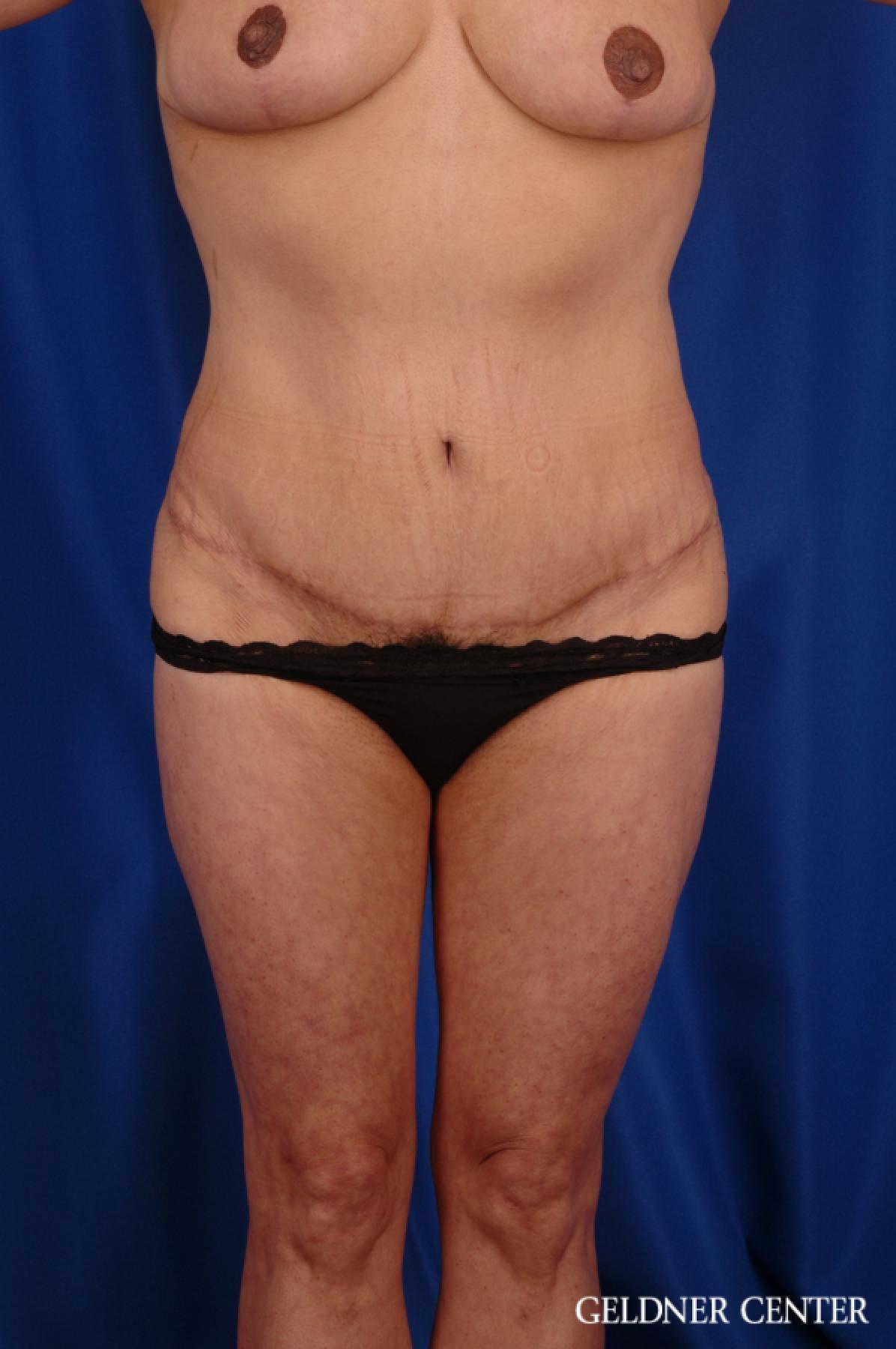 Tummy Tuck: Patient 16 - After 1