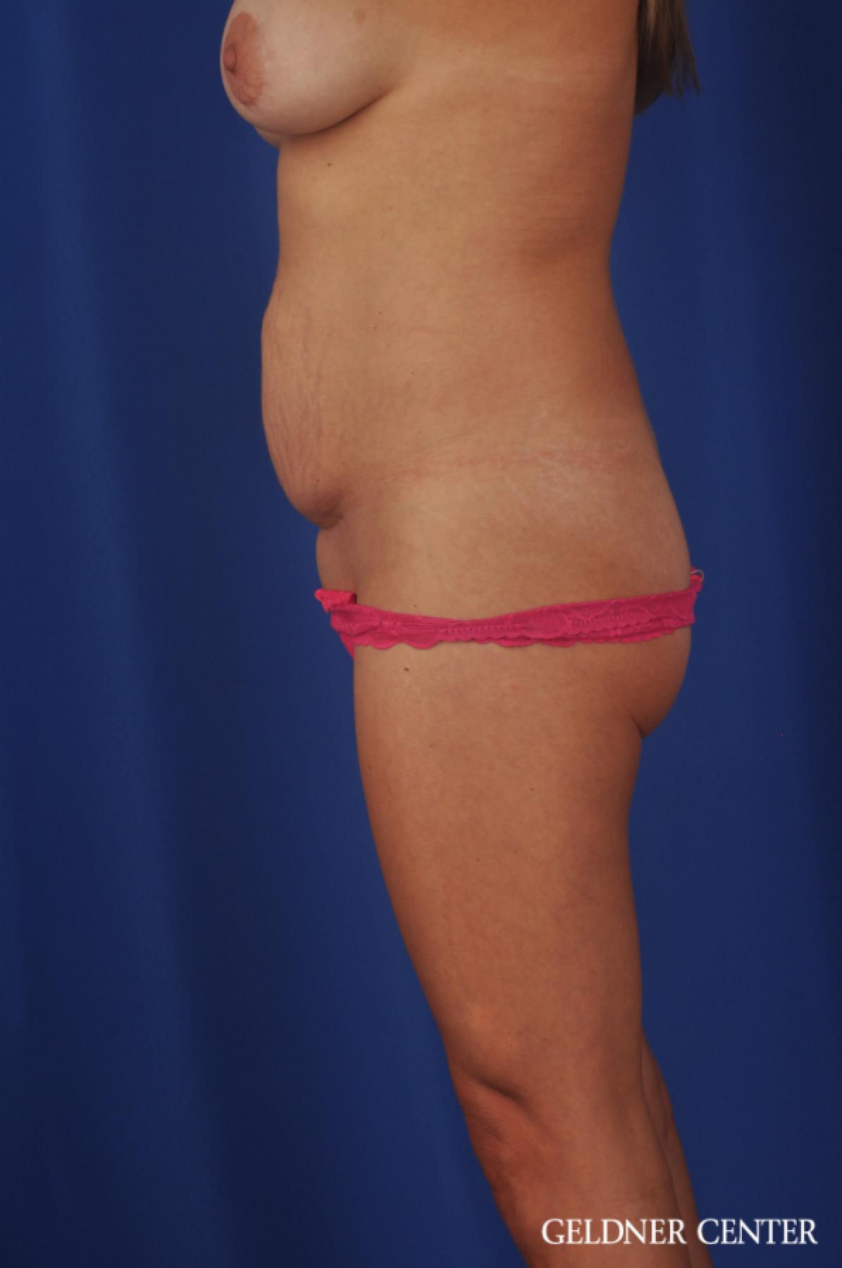 Liposuction: Patient 39 - Before 3