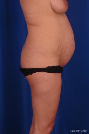 Lipoabdominoplasty: Patient 1 - Before Image 2