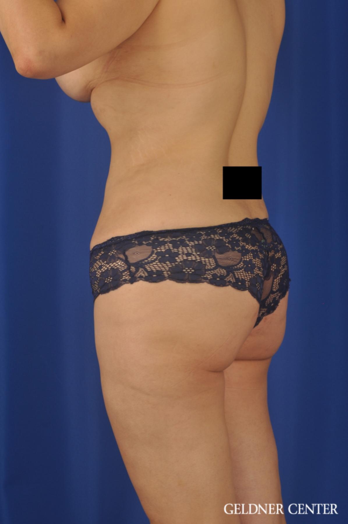 Tummy Tuck: Patient 24 - After 5