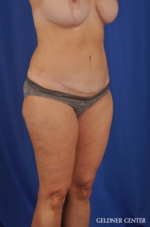 Tummy Tuck: Patient 23 - After 2