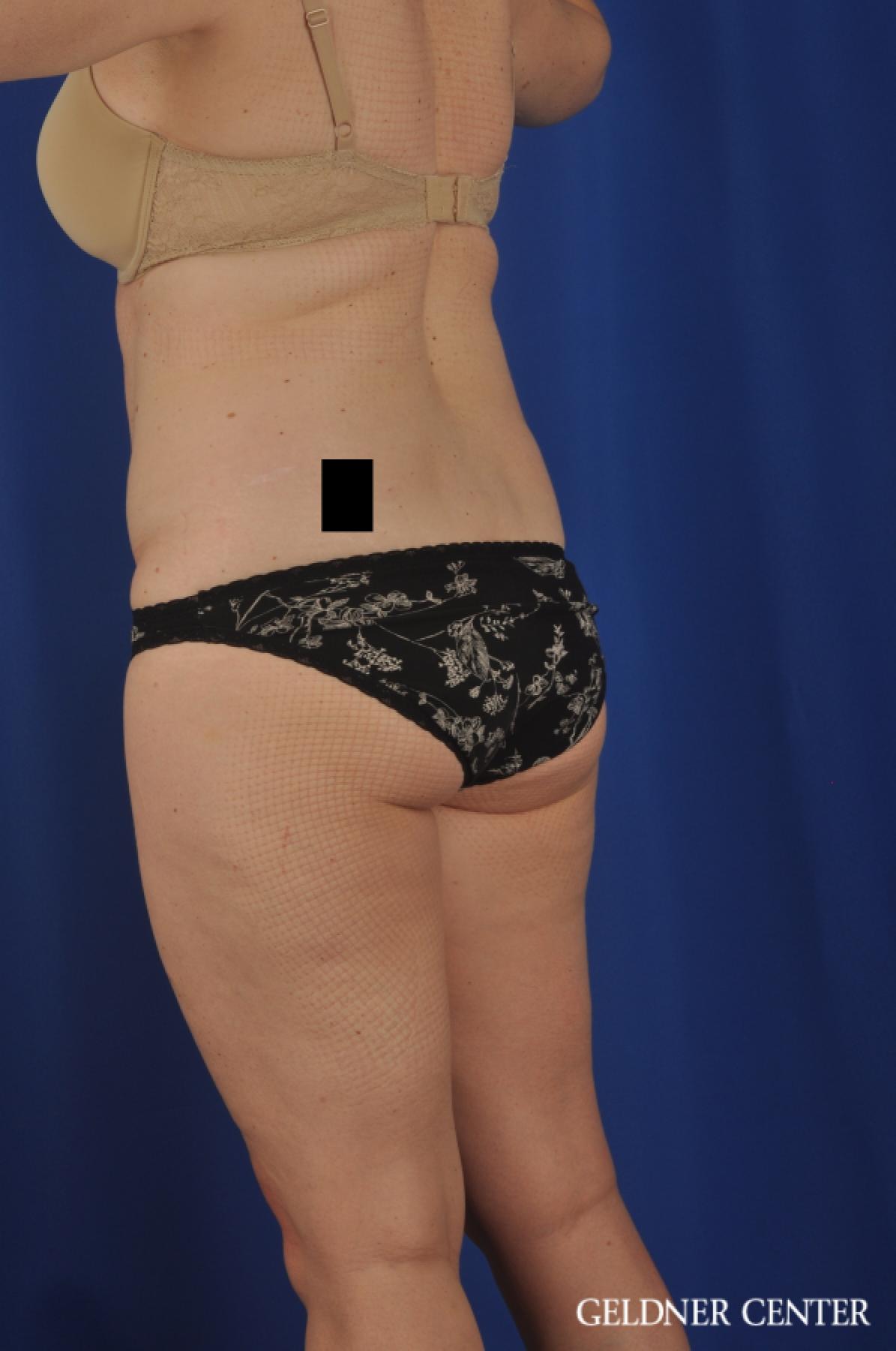 Tummy Tuck: Patient 22 - Before and After 5