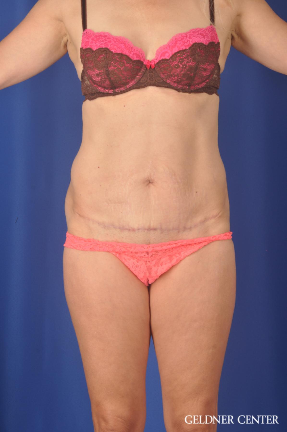 Chicago Abdominoplasty 11854 - After