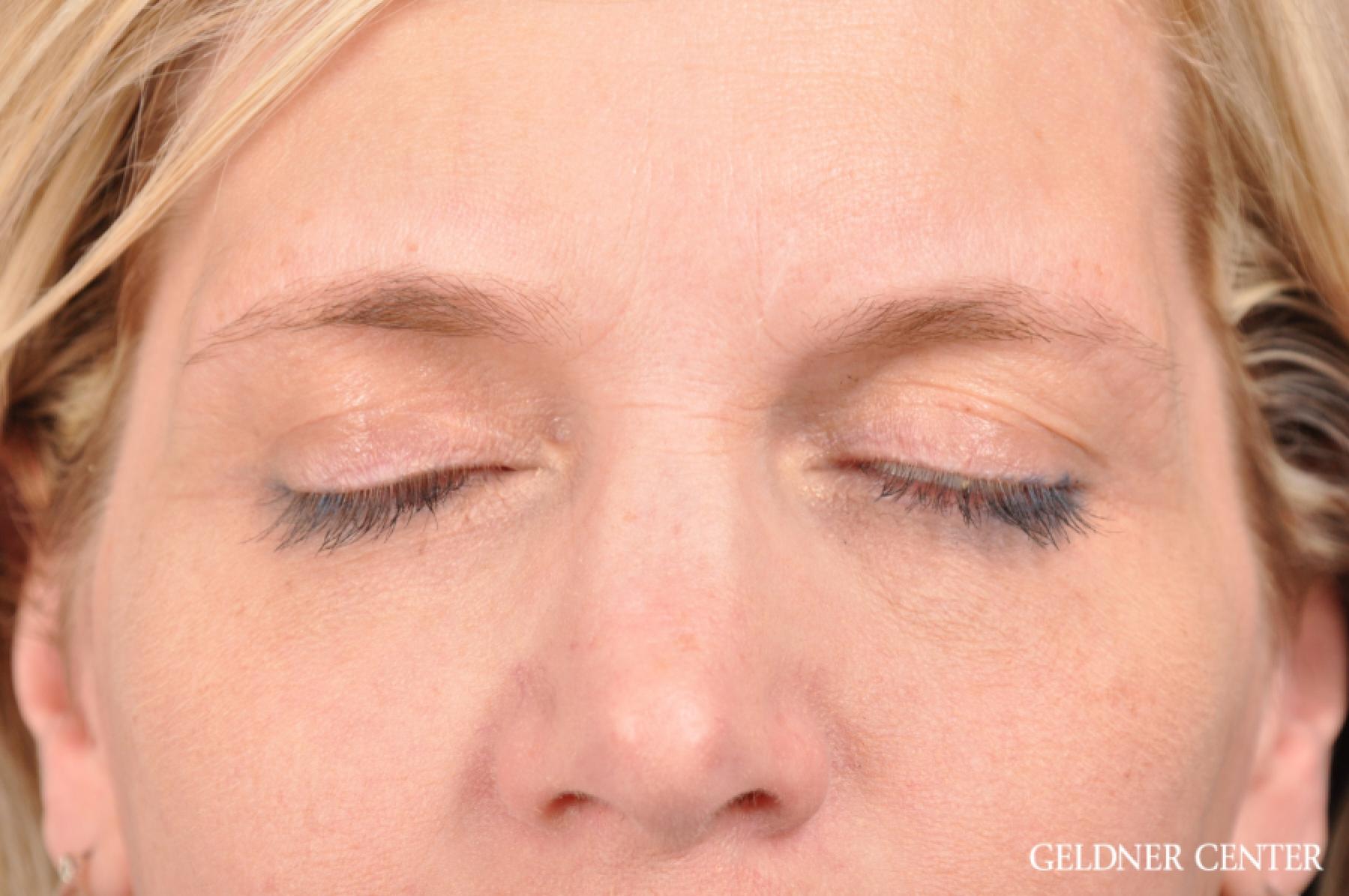 Eyelid Lift: Patient 9 - After 2