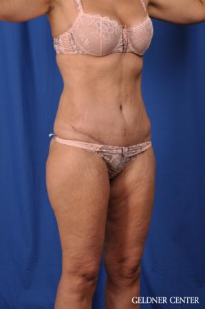 Lipoabdominoplasty: Patient 5 - After Image 2