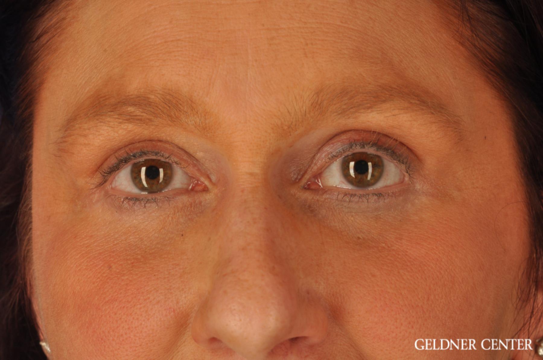 Eyelid Lift: Patient 7 - After 2