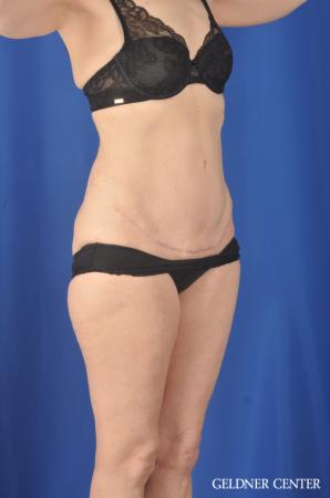 Chicago Abdominoplasty 11851 - After Image 2