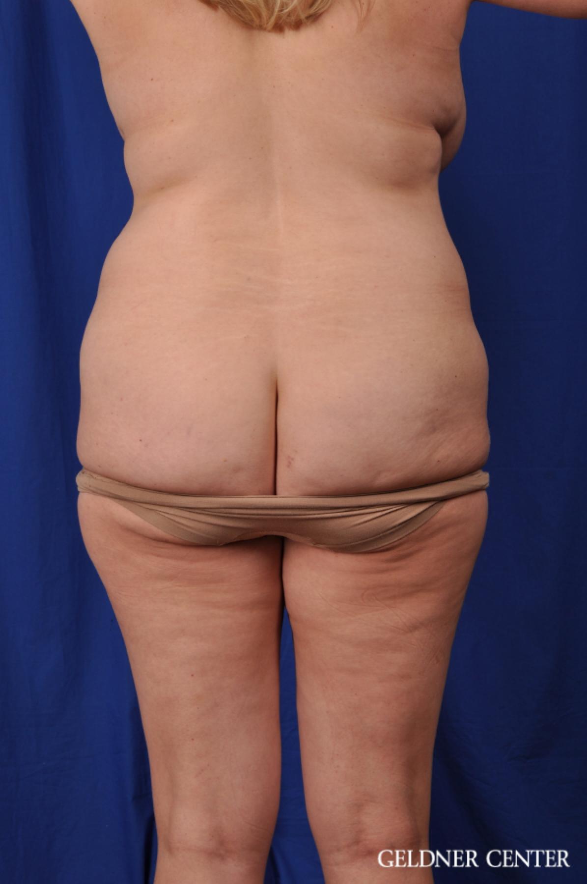 Tummy Tuck: Patient 23 - Before 4