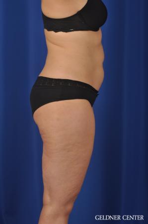 Liposuction: Patient 32 - Before 2