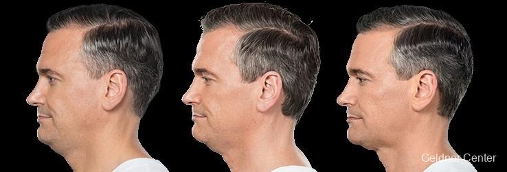 Kybella: Patient 2 - Before and After  