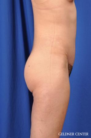 Tummy Tuck: Patient 32 - After 3