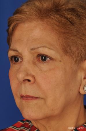 Neck Lift: Patient 1 - Before and After Image 4