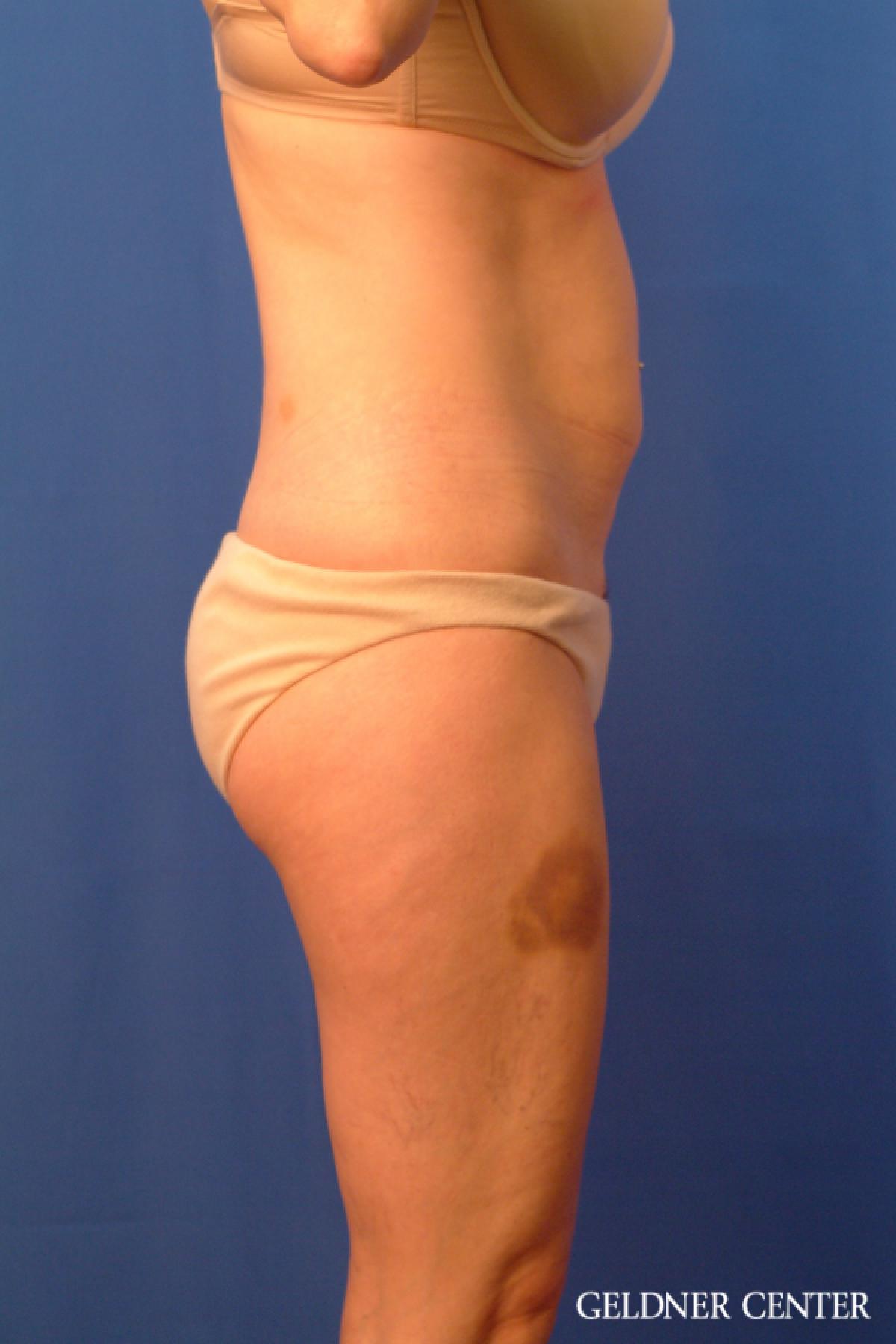 Tummy Tuck: Patient 36 - Before 3