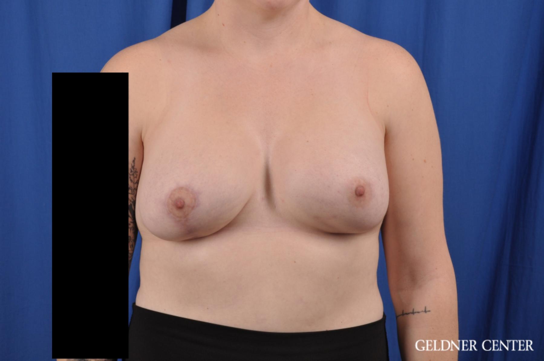 Breast Lift: Patient 53 - After 1
