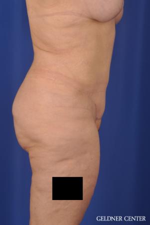 Liposuction: Patient 23 - After 3