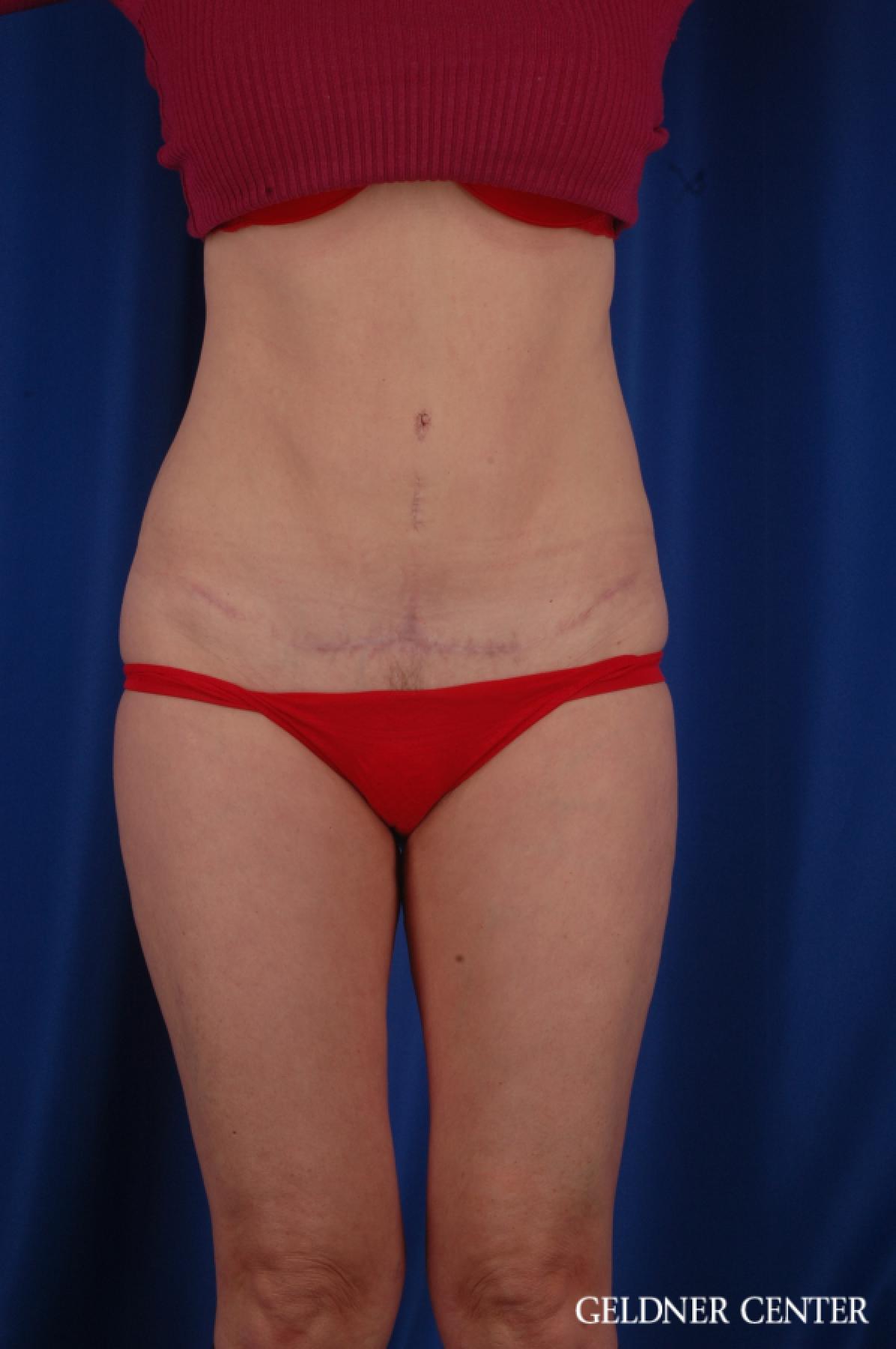 Tummy Tuck: Patient 36 - After 