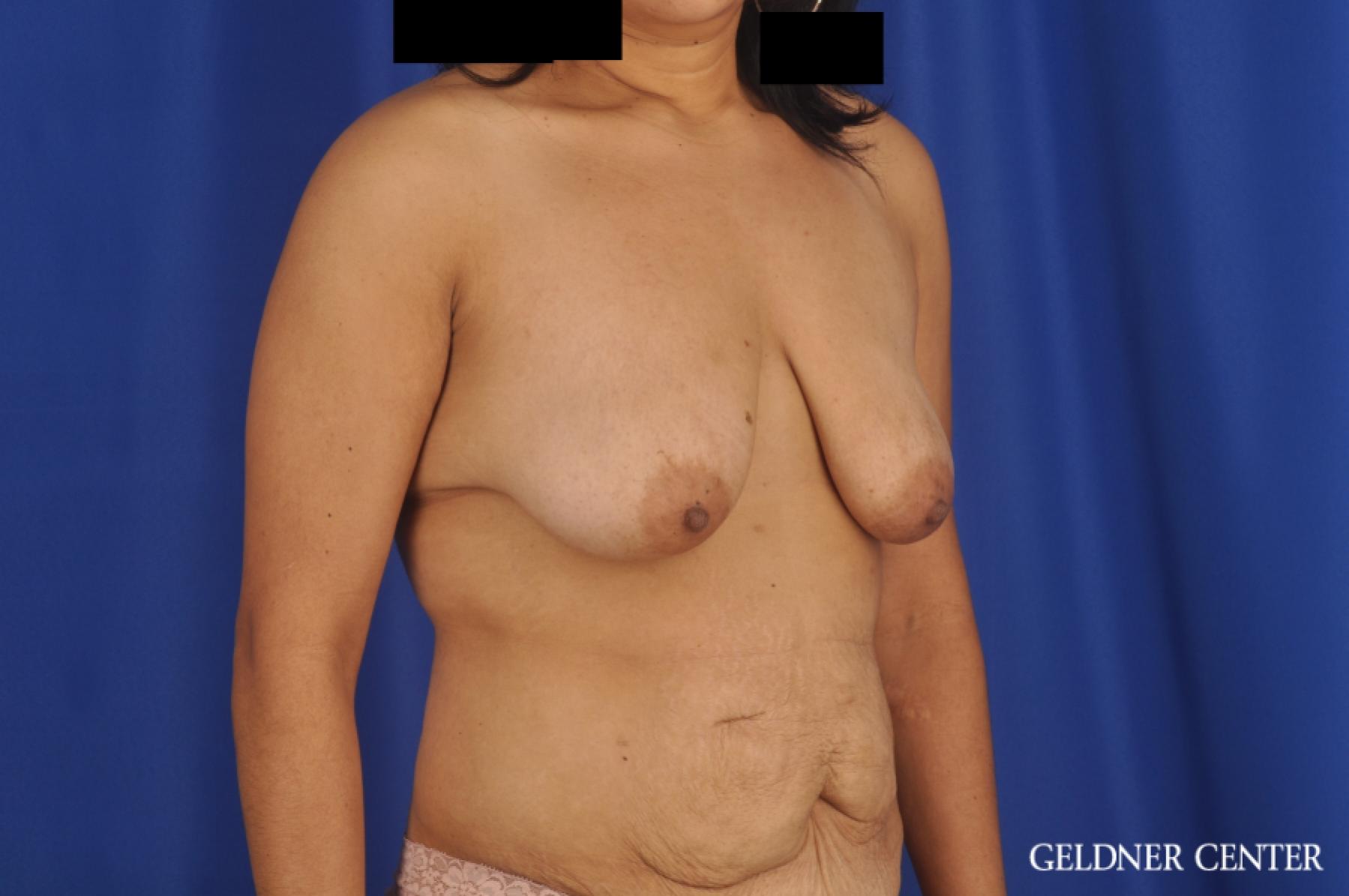Breast Lift: Patient 49 - Before 2
