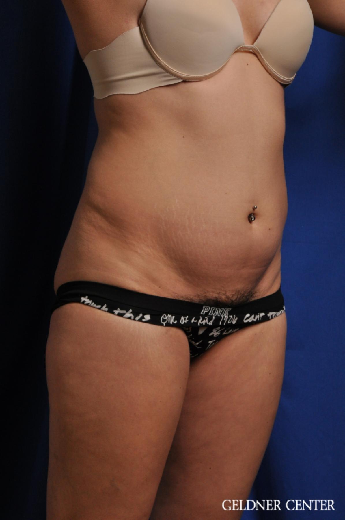 Tummy Tuck: Patient 32 - Before 2