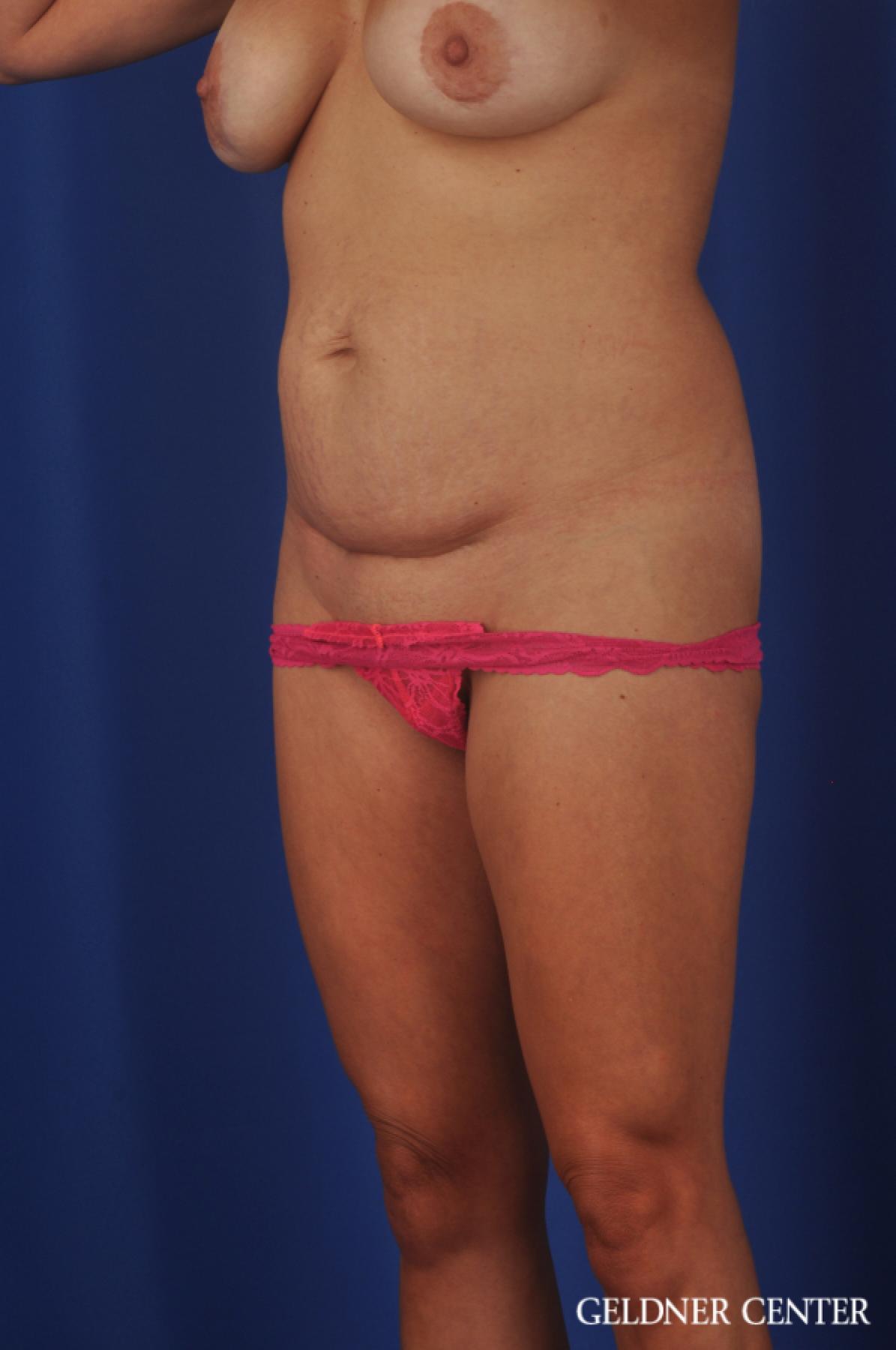 Liposuction: Patient 39 - Before 2
