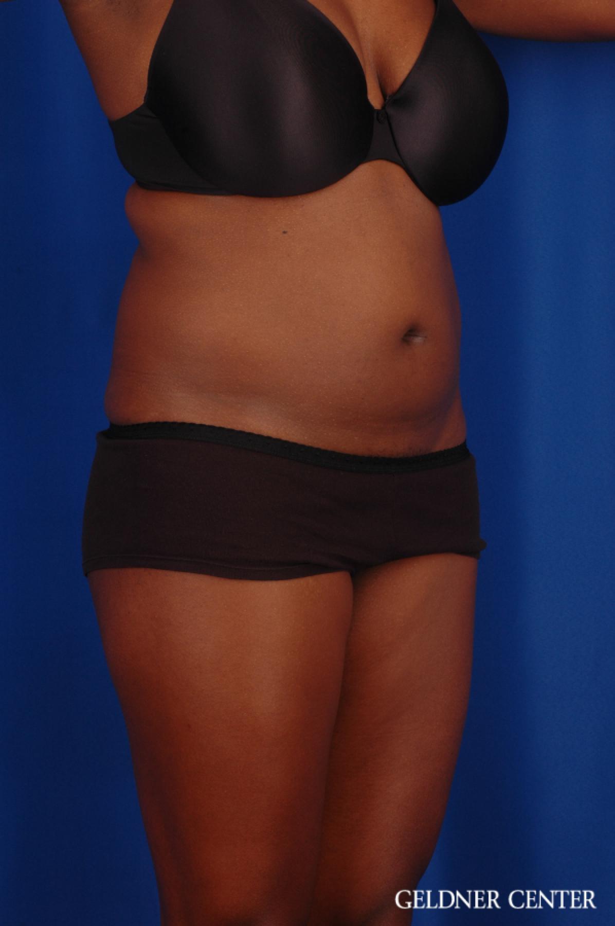 Liposuction: Patient 42 - Before 2