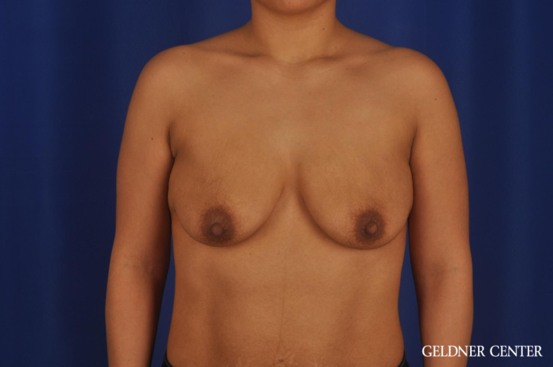 Breast Lift: Patient 55 - Before 1