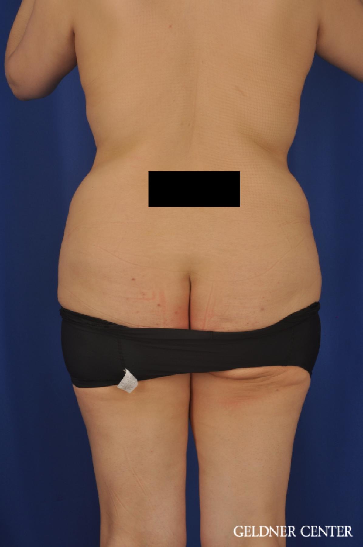 Tummy Tuck: Patient 24 - Before 4