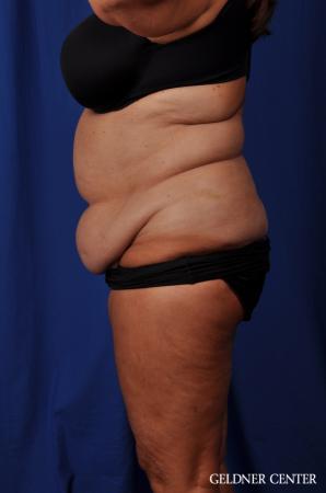 Lipoabdominoplasty: Patient 4 - Before and After Image 5