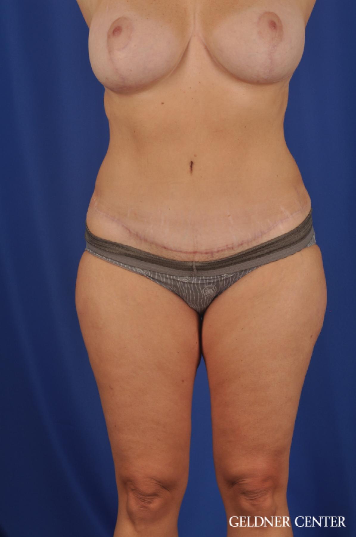 Tummy Tuck: Patient 23 - After 1