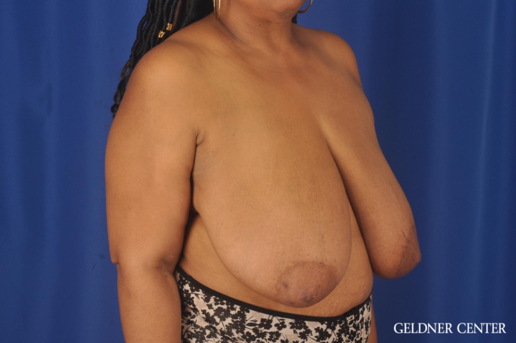Breast Reduction: Patient 22 - Before 3
