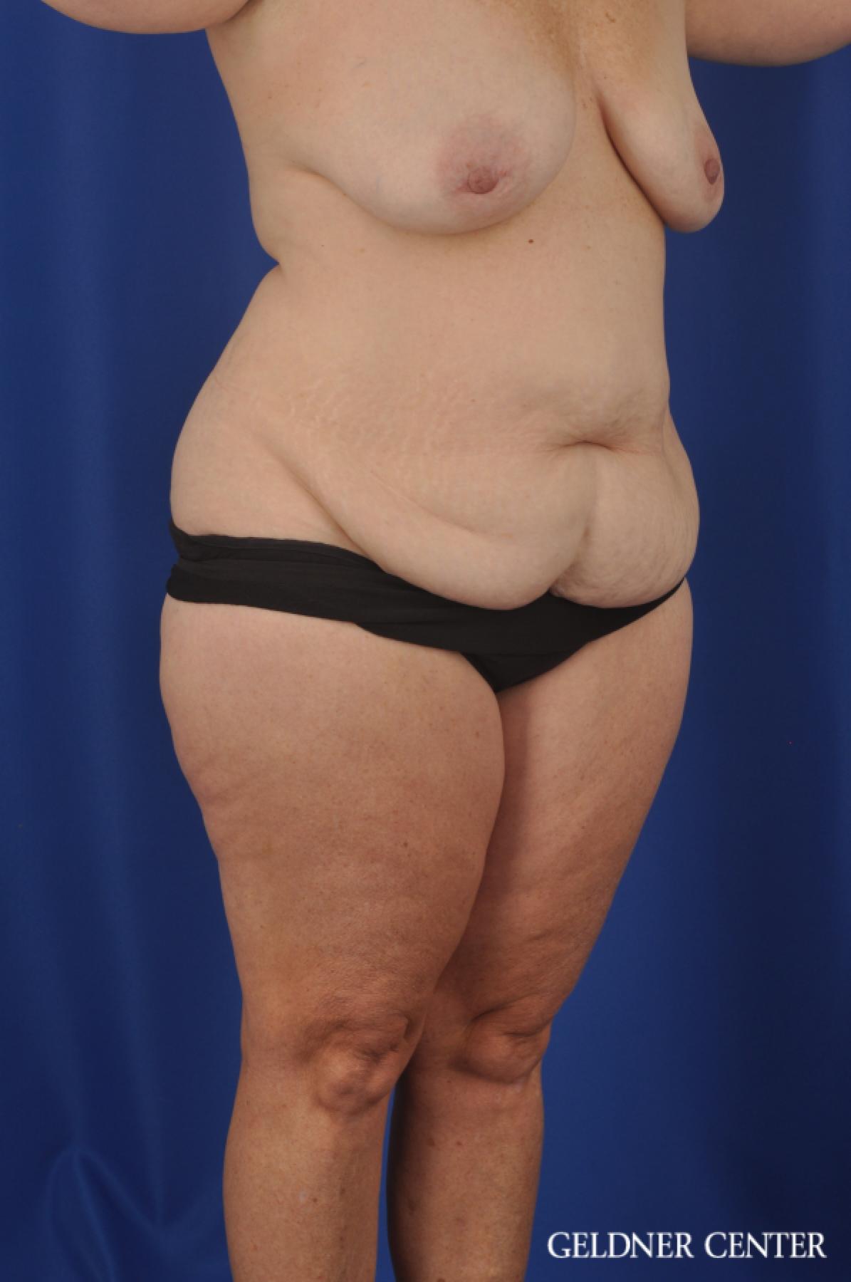 Abdominoplasty Patient 1 before and after photos - Before 2