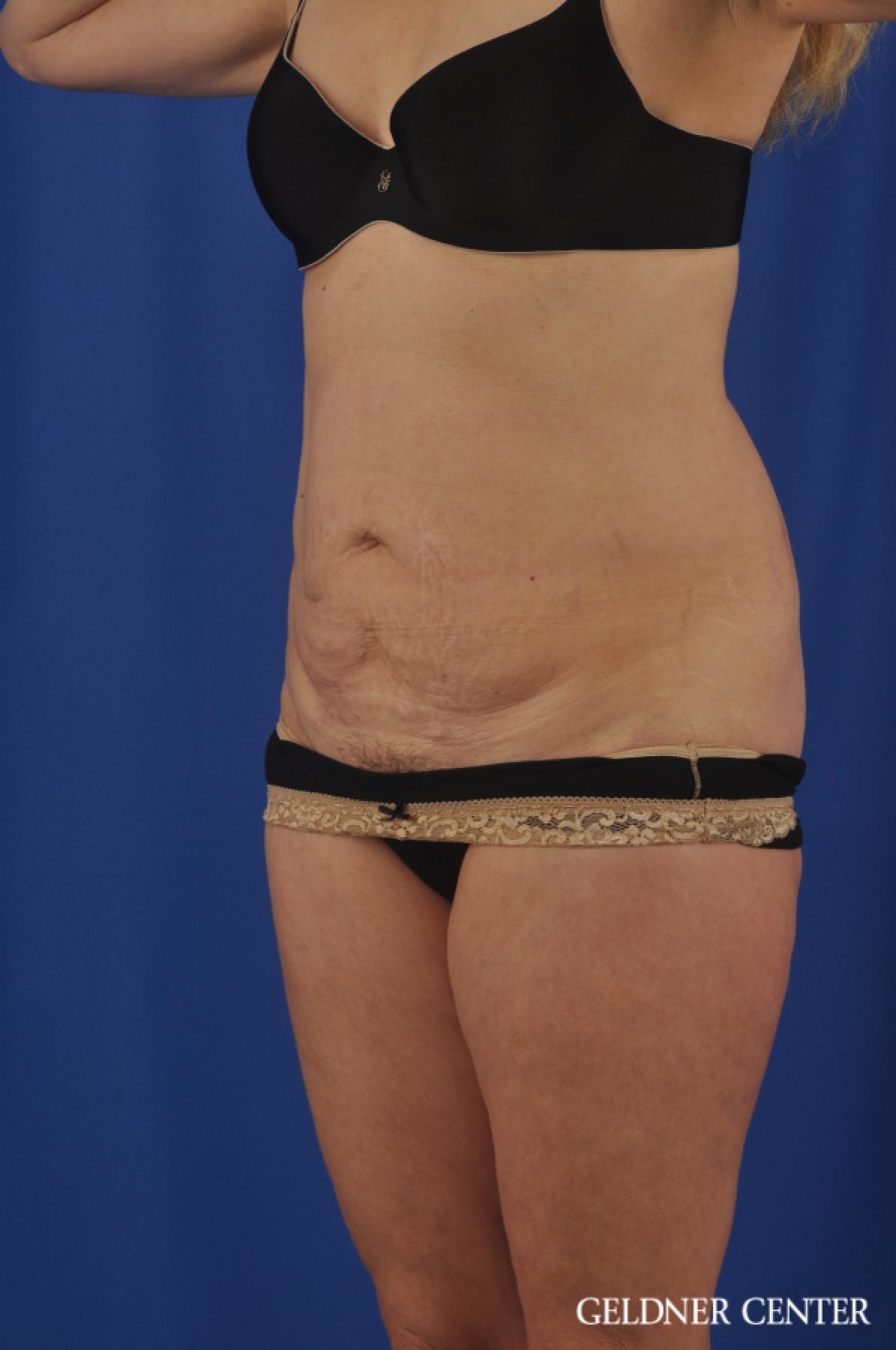Chicago Abdominoplasty 11854 - Before and After 4
