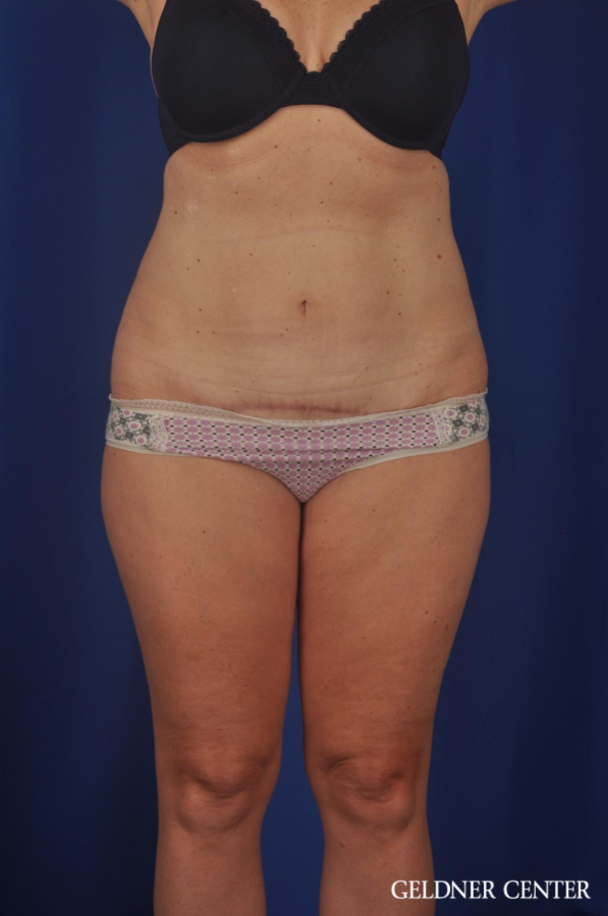 Tummy Tuck: Patient 22 - After 