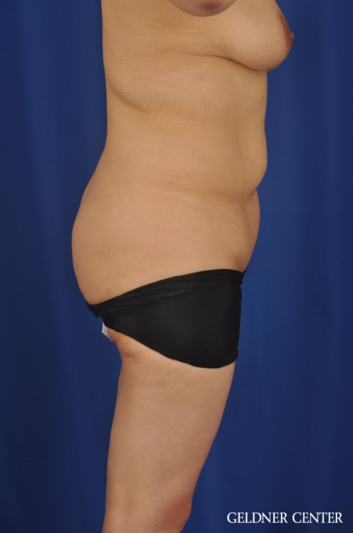 Tummy Tuck: Patient 24 - Before 3