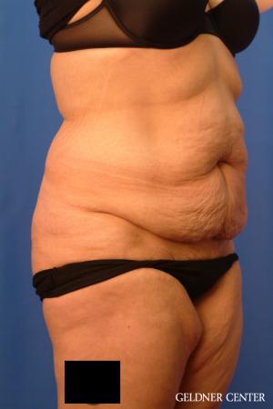 Liposuction: Patient 23 - Before 2
