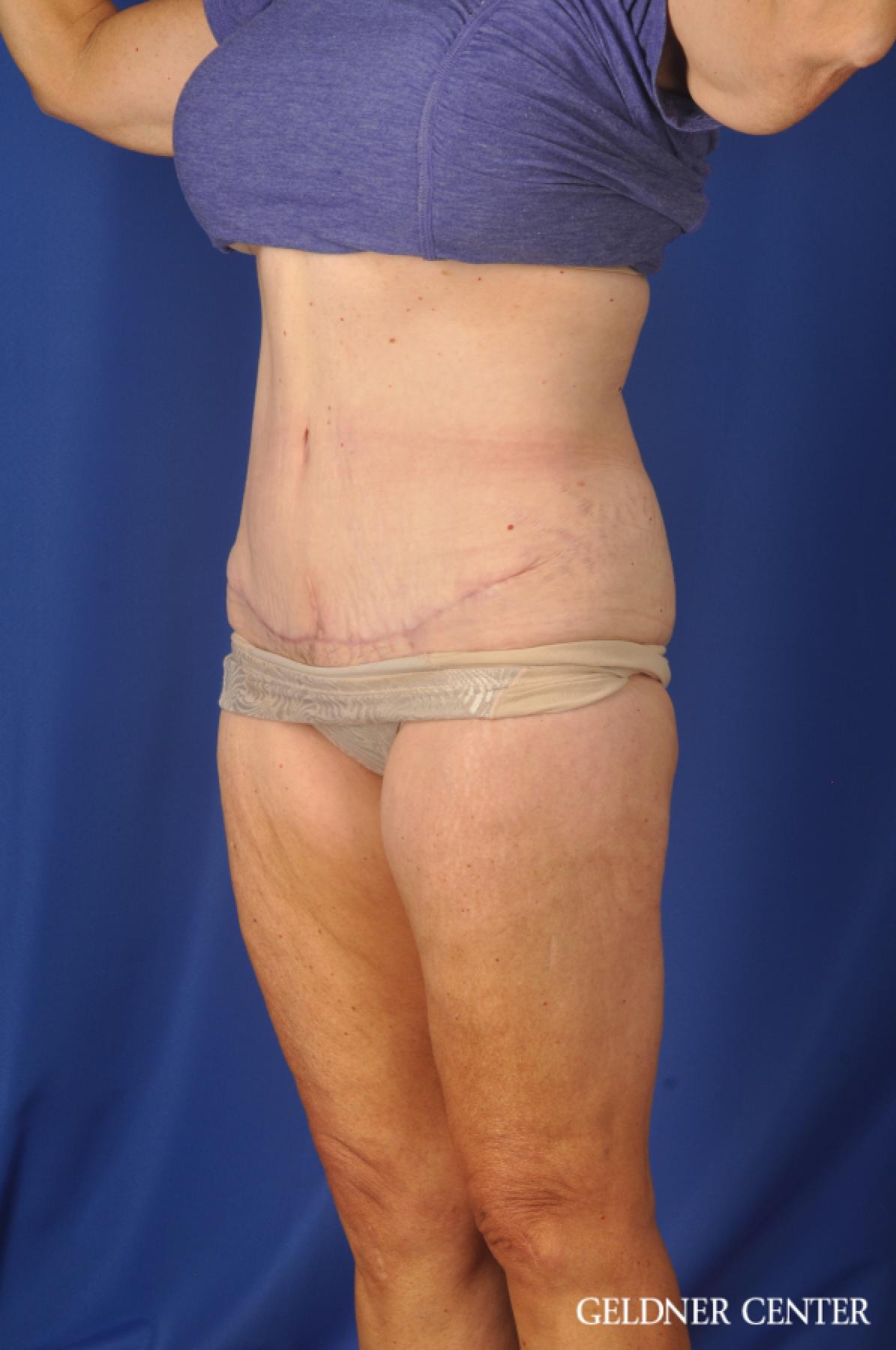 Abdominoplasty Lake Shore Dr, Chicago 11858 -  After 4