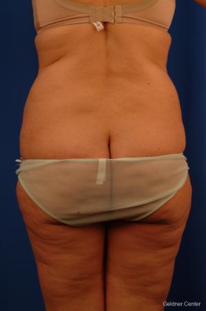 Lipoabdominoplasty: Patient 3 - Before and After Image 4